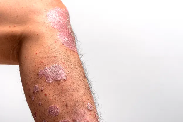 Psoriasis