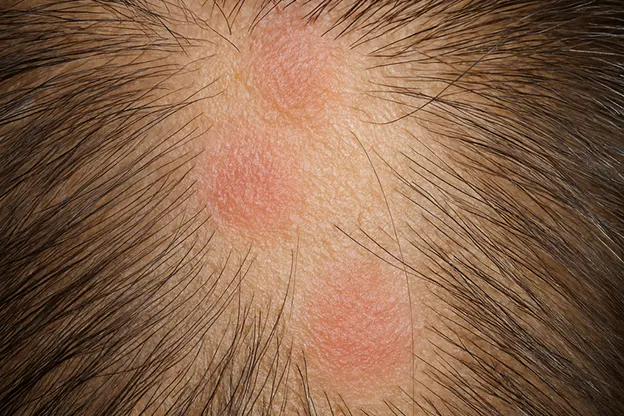 Scalp Inflammation and Disordered Hair Growth