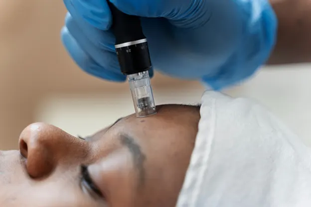 Microneedling for Blackheads, Whiteheads, and Blotches