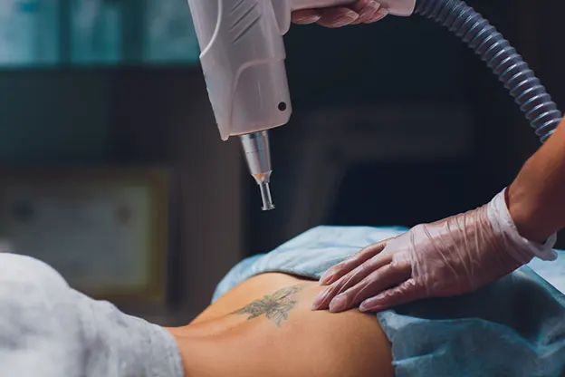Laser Skin Resurfacing for Tattoo Removal