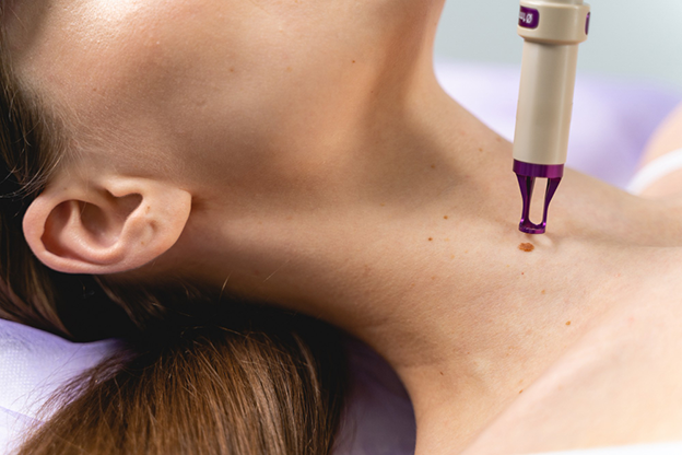 CO2 Laser Treatment for Mole Removal