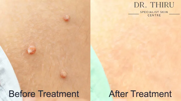 Patient Experience: Skin Tags Before and After Removal
