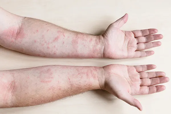 Atopic Dermatitis. This itchy, inflammatory skin disease is a form of eczema that often runs in families