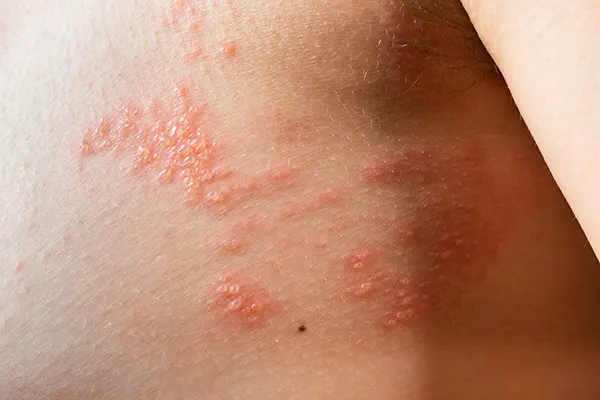 Shingles. This painful, blistering viral rash usually appears in a band-like pattern on one side of the body, often when the immune system is suppressed